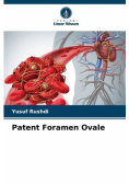 Patent Foramen Ovale