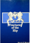 Fractures of the Hip