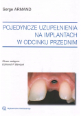 Pojedyncze uzupełnienia na implantach w odcinku przednim