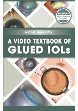 A Video Textbook of Glued IOLs