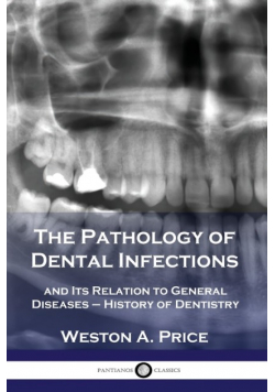 The Pathology of Dental Infections