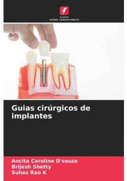 Guias cirúrgicos de implantes