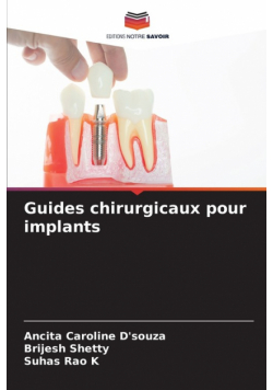 Guides chirurgicaux pour implants