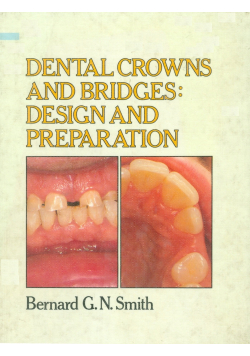Dental Crowns and bridges