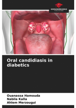 Oral candidiasis in diabetics