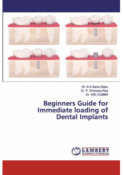 Beginners Guide for Immediate loading of Dental Implants