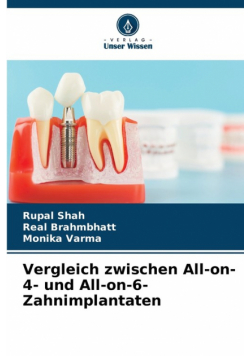 Vergleich zwischen All-on-4- und All-on-6-Zahnimplantaten