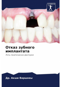 Отказ зубного имплантата
