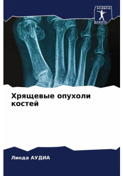 Хрящевые опухоли костей