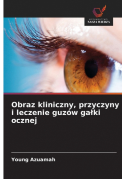 Obraz kliniczny, przyczyny i leczenie guzów gałki ocznej