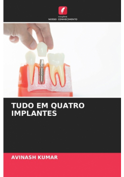 Tudo Em Quatro Implantes