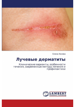 Luchevye Dermatity