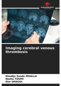 Imaging cerebral venous thrombosis