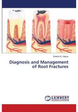 Diagnosis and Management of Root Fractures