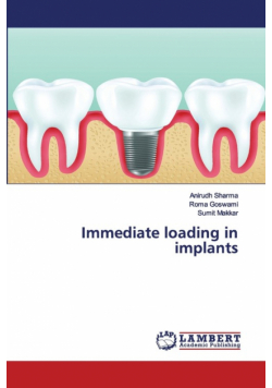 Immediate loading in implants