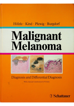 Malignant Melanoma