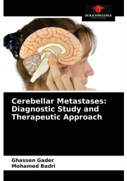 Cerebellar Metastases