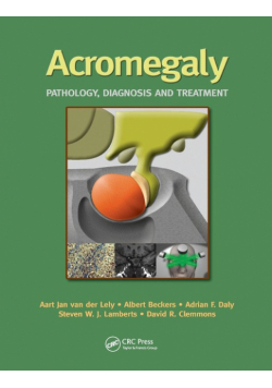 Acromegaly