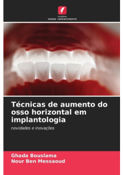 Técnicas de aumento do osso horizontal em implantologia