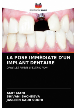 La Pose Immédiate D'un Implant Dentaire