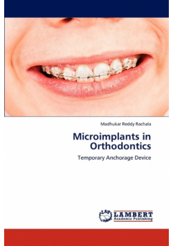 Microimplants in Orthodontics