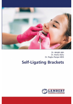 Self-Ligating Brackets