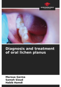 Diagnosis and treatment of oral lichen planus