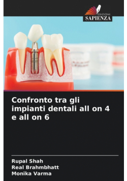 Confronto tra gli impianti dentali all on 4 e all on 6