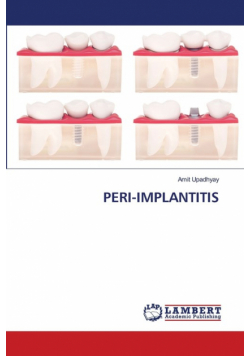 Peri-Implantitis
