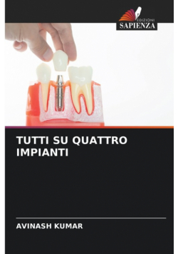 Tutti Su Quattro Impianti