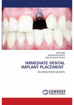 Immediate Dental Implant Placement
