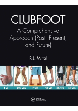 Clubfoot