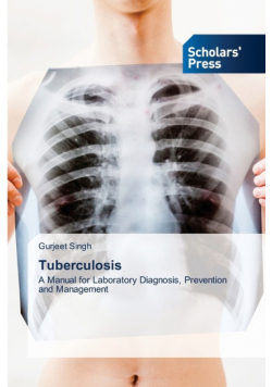 Tuberculosis