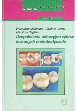 Uzupełnienia adhezyjne zębów leczonych endodontycznie