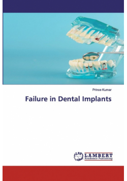 Failure in Dental Implants