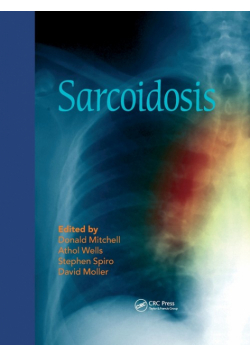 Sarcoidosis