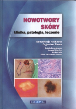 Nowotwory skóry klinika patologia leczenie