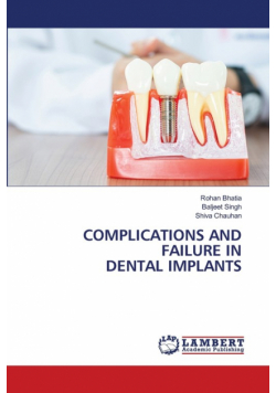 Complications And Failure In Dental Implants