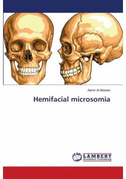 Hemifacial microsomia