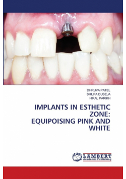 Implants In Esthetic Zone