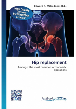 Hip replacement