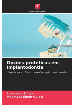 Opções protéticas em Implantodontia