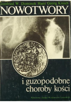 Nowotwory i guzopodobne choroby kości