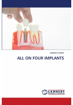 All On Four Implants